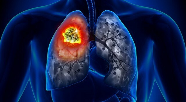 A tüdőrákban elhunytak száma szűrővizsgálatokkal csökkenthető!
